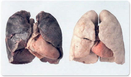 Imagem de pulmão com e sem cancro. Vacina pode ser salvação,