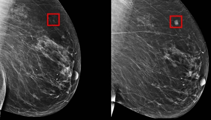 Imagem mamografia que deteta cancro da mama