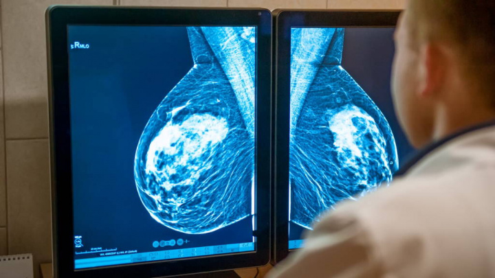 Google IA cancro mama Inteligência Artificial