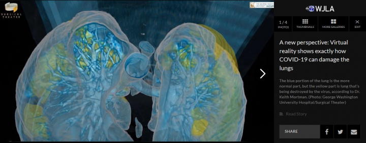 A azul os pulmões normais e a amarelo a parte dos pulmões danificada pelo vírus, segundo o Dr. Keith Mortman.