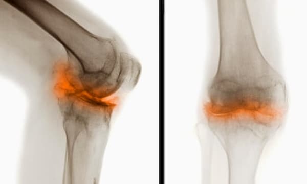 Imagem de joelho com lesão na cartilagem que poderá ter hidrogel