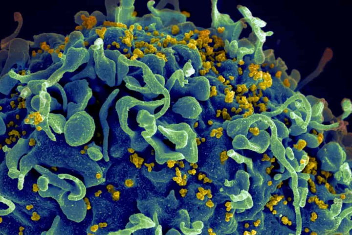Células humanas infetadas pelo HIV