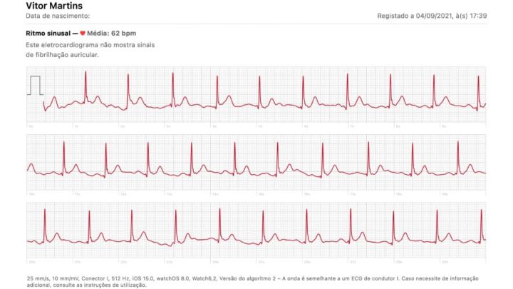Imagem eletrocardiograma feito pelo Apple Watch Series 6