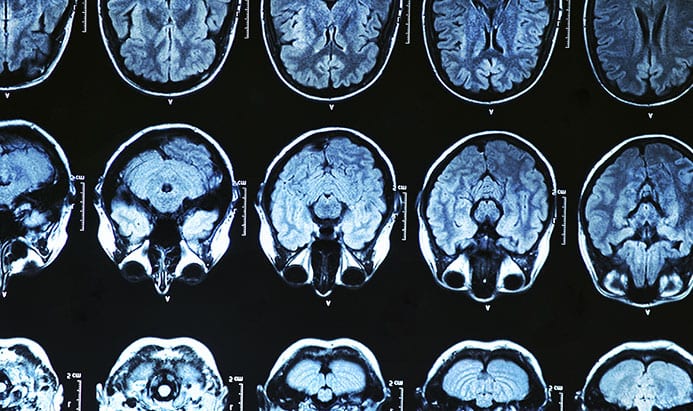 Investigação liderada por português: Proteína cerebral atrasa "origem" de Alzheimer