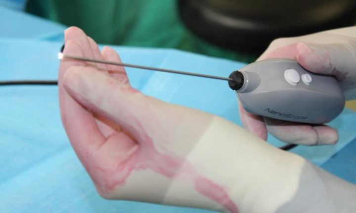 CHUCB: primeira cirurgia pouco invasiva do punho com recurso ao NanoScope