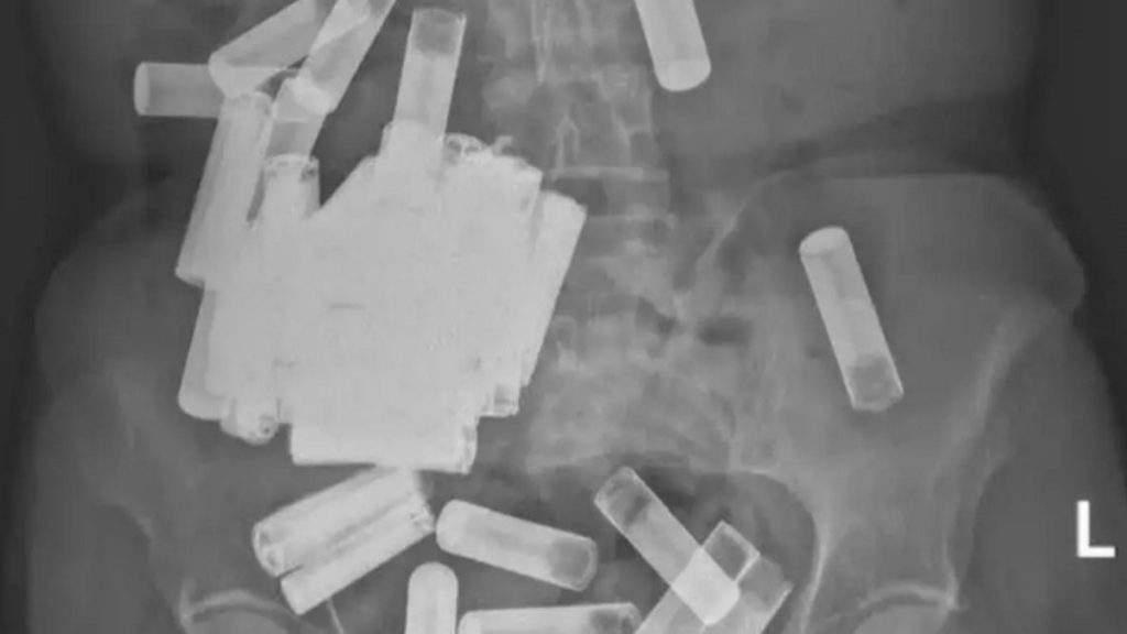 Médicos irlandeses retiraram 50 pilhas do estômago e intestino de uma mulher