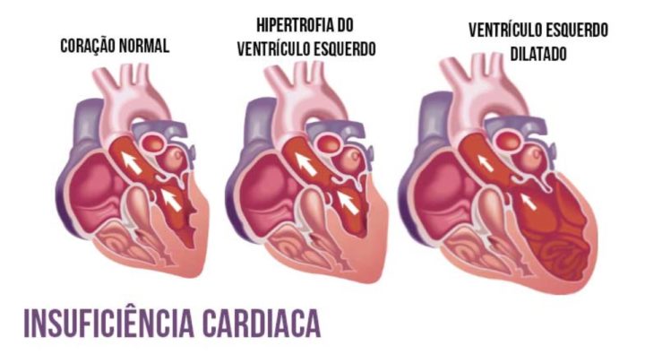 Imagem de condição cardíaca normal e anormal