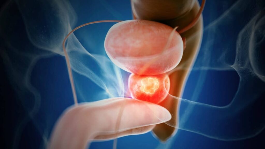 Melhoria da condição física reduz o risco de cancro da próstata, diz estudo