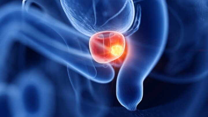 Los científicos esperan que los casos de cáncer de próstata se dupliquen en 20 años