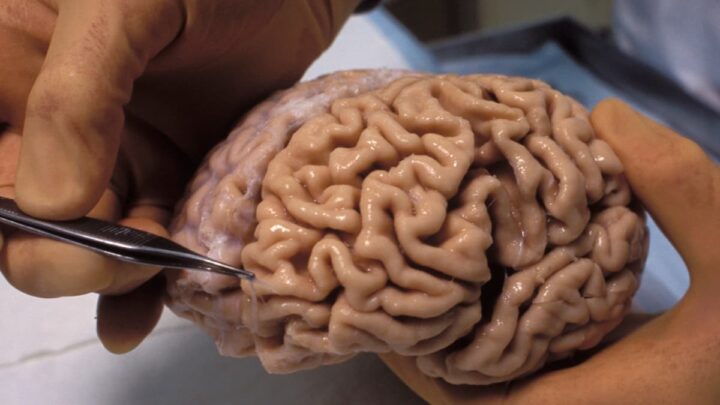 Imagem cérebro humano congelado