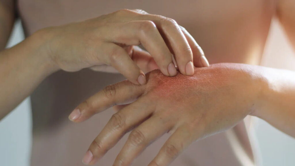 Por que é que coçar reduz a comichão na pele? Será que deve fazê-lo?