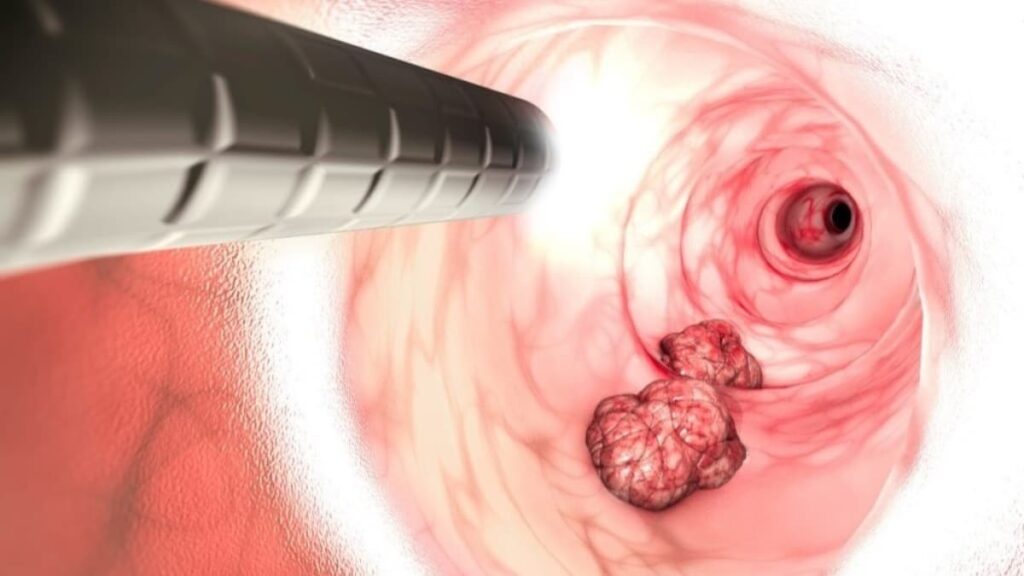 Há um cancro a aumentar rapidamente nas pessoas mais jovens