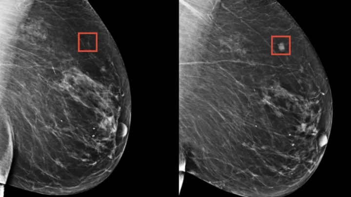 Ilustração de deteção do cancro da mama com recuso à Inteligência Artificial