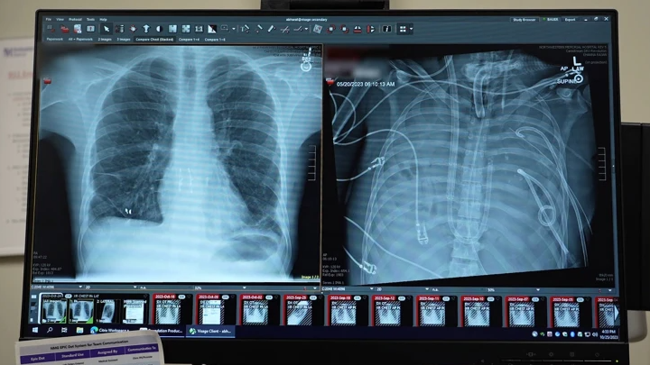 Radiografias mostram os pulmões novos (à esquerda) e os pulmões antigos (à direita) do doente de 33 anos.