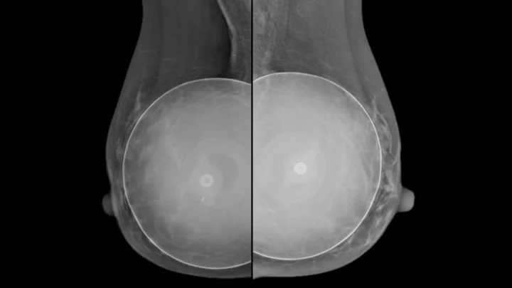 Ilustração de cancro raro associado a implantes mamários