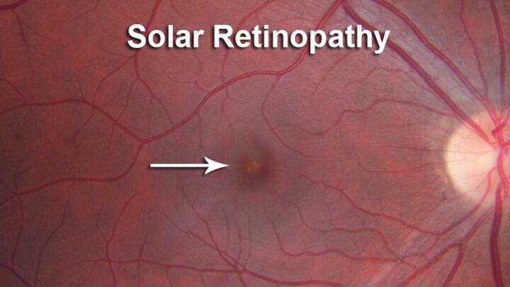 Retinopatia solar (ou maculopatia solar).
